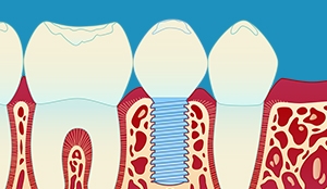 Enkelt implantat