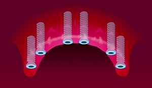 Implantat helkjeve