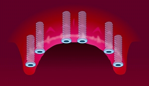 Implantat helkjeve