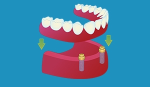 Implantatforankra heilprotese